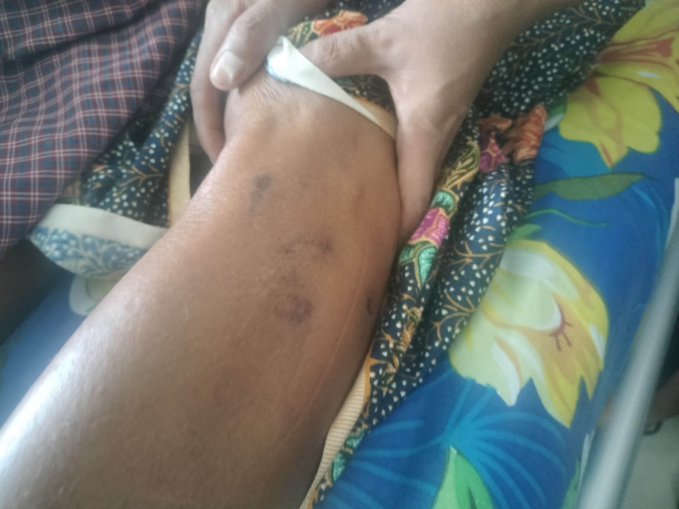 家属质疑:患者EX未接种狂犬疫苗